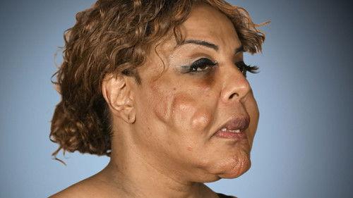 Botched Season 3 Episode 1 - Foreign Bodies