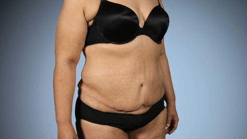 Botched Season 3 Episode 5 - Super Fupa