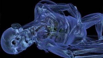 1000 Ways to Die Season 2 Episode 9 - Waking Up Dead