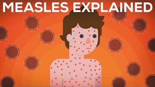 Kurzgesagt - In a Nutshell Season 3 Episode 2 - Measles Explained — Vaccinate or Not?