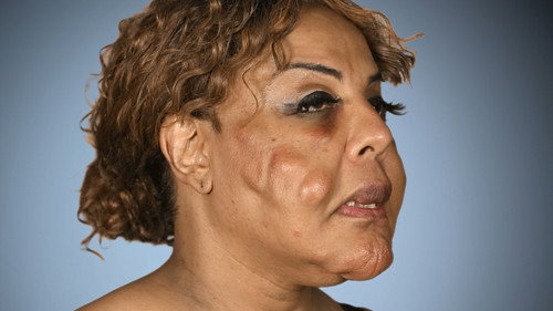Botched Season 3 Episode 1 - Foreign Bodies